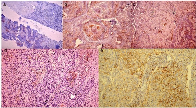 Immunohistochemical Expression of Programmed Cell Death Ligand 1 in ...