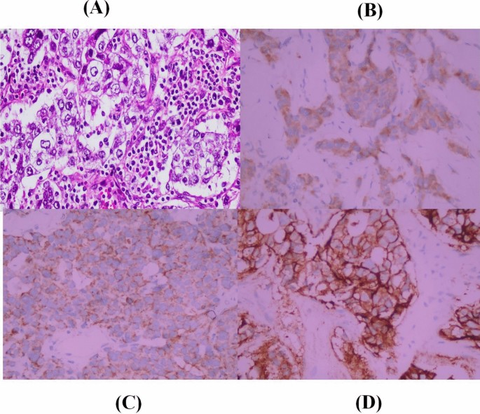 Immunohistochemical Profiling of EGFR in Triple-Negative Breast Cancer ...
