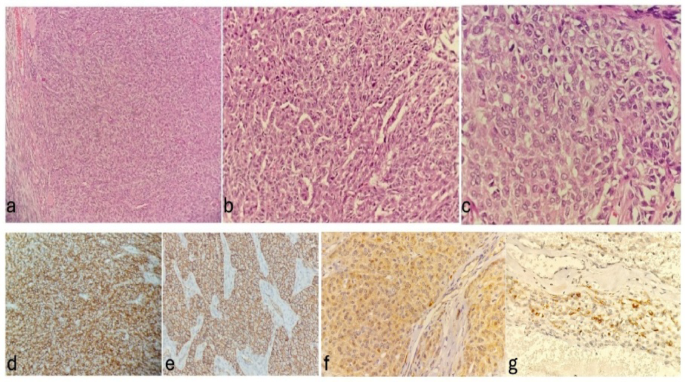 Jgct Juvenile Granulosa Cell Ovarian Tumour- Case Study with Radio ...