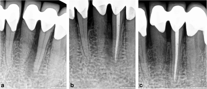 Outcome of 940-nm diode laser-assisted endodontic treatment of teeth with  apical periodontitis: a retrospective study of clinical cases | SpringerLink