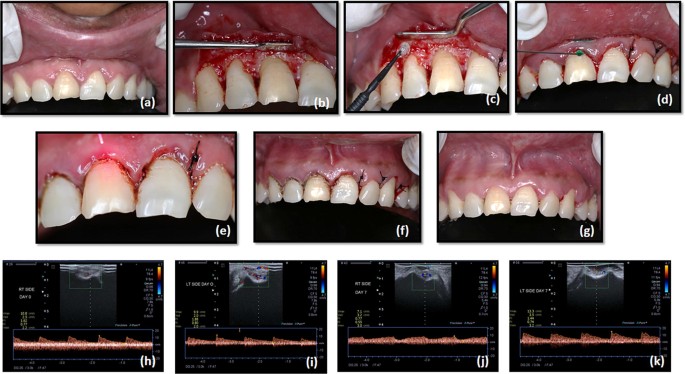 Non Surgical Periodontal Consent Form Aliso Smiles