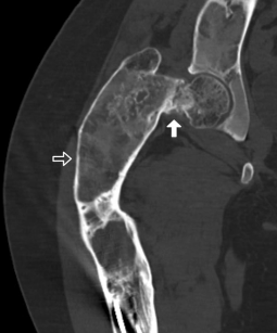 gesichts fibrose dysplasie