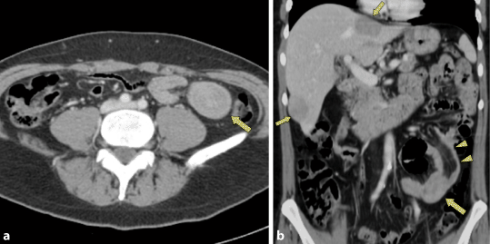 Ileus Durch Intussuszeption Eines Dunndarmlymphoms Springerlink