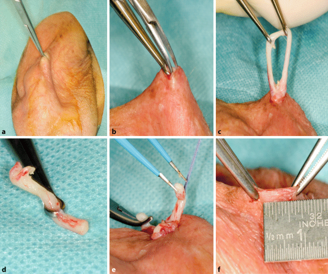 Minimalinvasive Vasektomie und Vasovasostomie | SpringerLink
