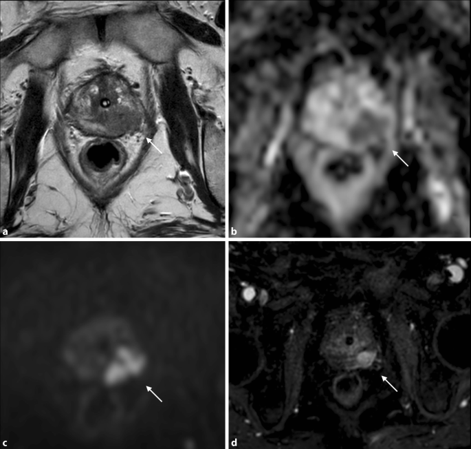 Psa Et Irm Comment S En Servir De Facon Raisonnable Pour La Detection Du Cancer De La Prostate Springerlink Psa Et Irm Comment S En Servir De Facon Raisonnable Pour La Detection Du Cancer De La Prostate Springerlink