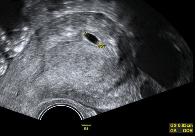 Die Gestationsaltersbestimmung mit Ultraschall | SpringerLink