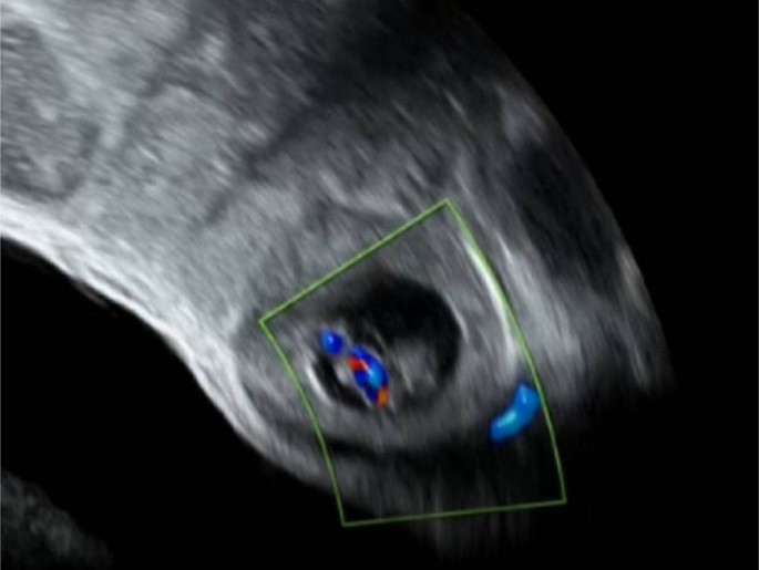 Sichere und weniger sichere Ultraschallmarker der extrauterinen  Schwangerschaft (EUG) | SpringerLink