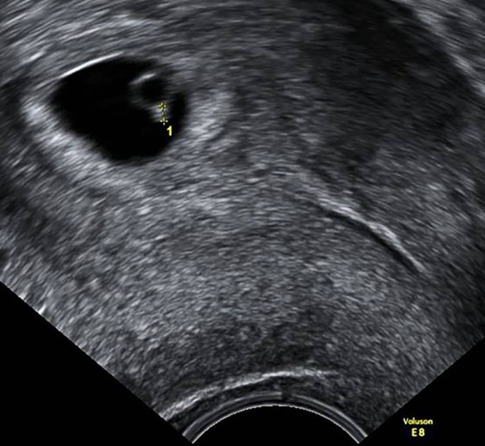 Der Dottersack Ein Wichtiger Marker Beim Ultraschall In Der Fruhschwangerschaft Springerlink