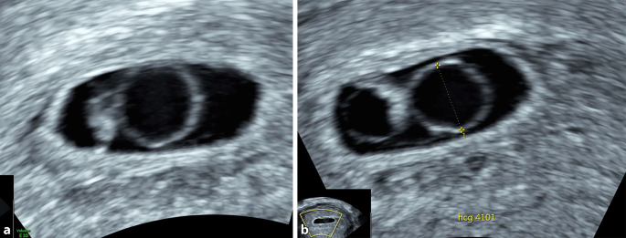 Ultraschall siebte schwangerschaftswoche 7 ssw
