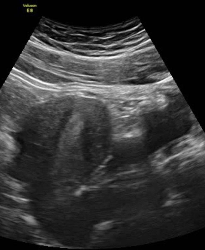Ultraschall blase Urologe will