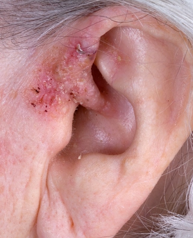 Hauttumoren bei Älteren richtig differenzieren | SpringerLink