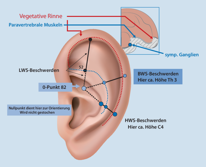 Behandlung von Rückenschmerzen mit Ohrakupunktur | SpringerLink