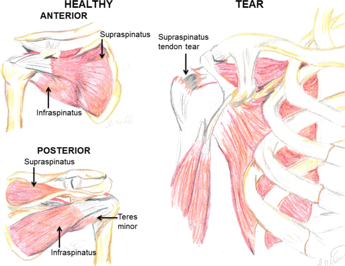 bilateral rotator cuff