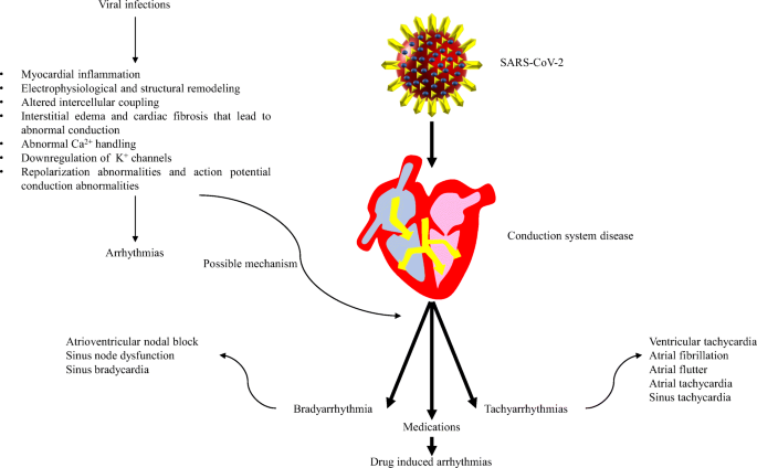 Arrhythmia In Covid 19 Springerlink Arrhythmia In Covid 19 Springerlink