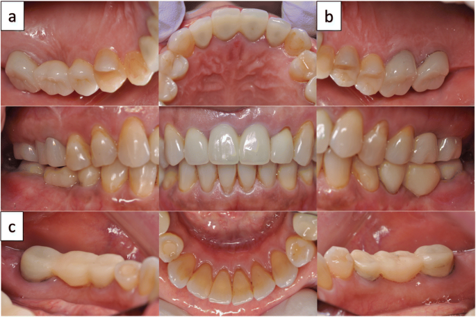 Allergic Reaction to Zirconia Ceramic Bridge Cementation Using a Dental  Adhesive Resin Cement: a Case Report | SpringerLink