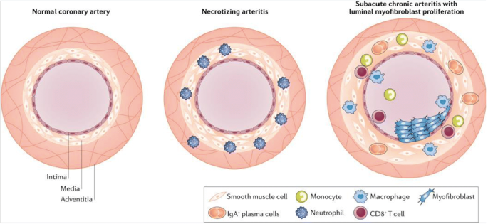 Refractory Kawasaki Disease—a Challenge Pediatrician | SpringerLink