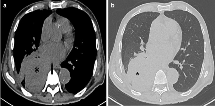 Poorly Differentiated Lung Cancer with Intracardiac Extension Causing  Malignant Stroke in a Peritoneal Dialysis Patient: a Case Report |  SpringerLink