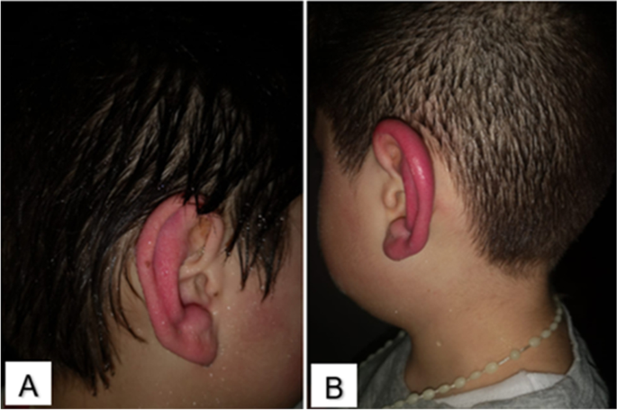 Secondary Red Ear Syndrome in a Pediatric Patient: a Case Report | SN Comprehensive Clinical Medicine