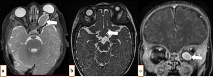 Optic Pathway Glioma of Infancy: A Case Report and Literature Review ...
