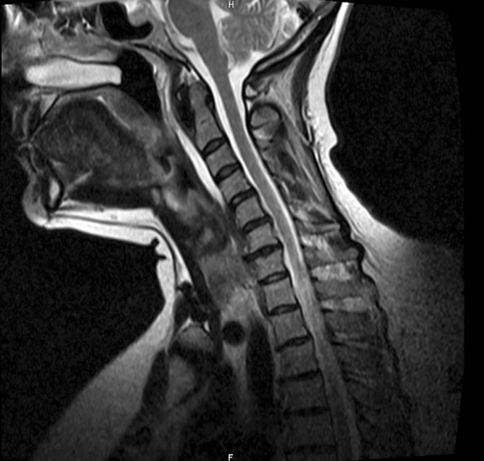Starke Kopf Und Nackenschmerzen Bei Einer Jungen Patientin Springerlink