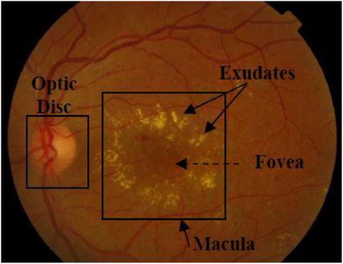 retinal edema)