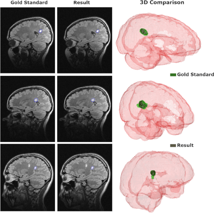 Multiple sclerosis segmentation method in magnetic resonance imaging using  fuzzy connectedness, binarization, mathematical morphology, and 3D  reconstruction | SpringerLink