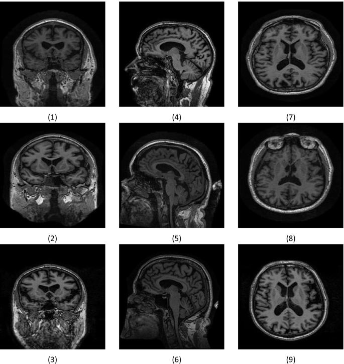 Computer-aided diagnosis of Alzheimer's disease by MRI analysis and  evolutionary computing | SpringerLink