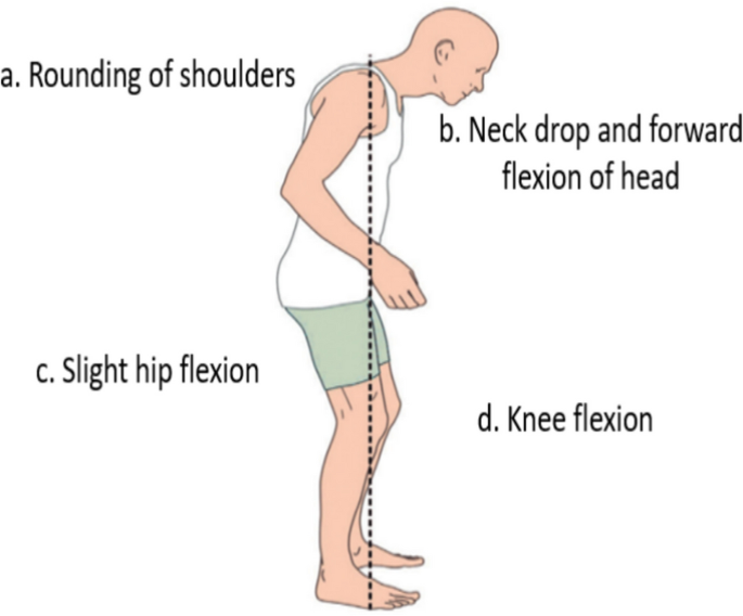 Gait analysis and treatment strategies for motor symptoms in Parkinson ...