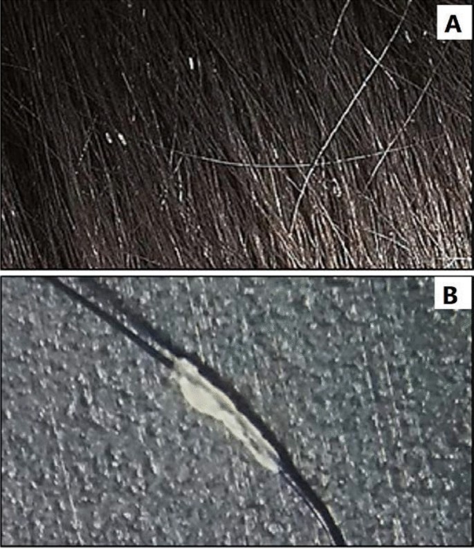 Pediculosis capitis; the importance of accurate differentiation of nits and  hair casts | SpringerLink