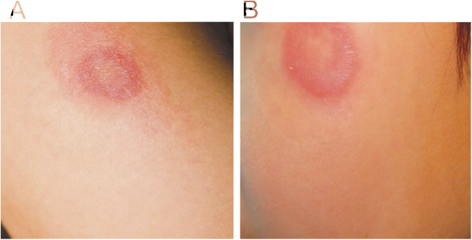 Tinea Corporis Caused By Trichophyton Equinum Transmitted From Asymptomatic Dogs To Two Siblings Springerlink