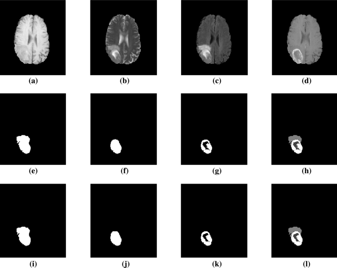 Segmentation Of Multi-Modal Mri Brain Tumor Sub-Regions Using Deep Learning  | Springerlink