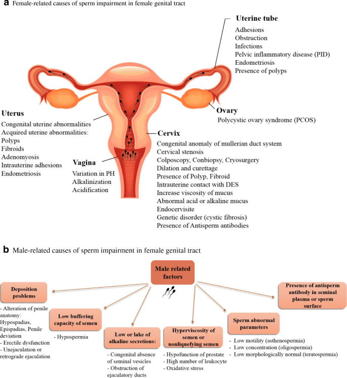 The Potential Relationship Between Different Human Female Reproductive  Disorders and Sperm Quality in Female Genital Tract | SpringerLink