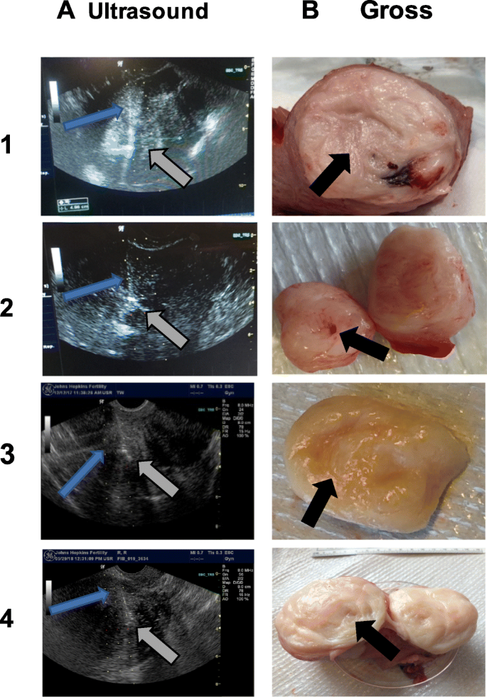 can glutathione shrink fibroid Glutathione vs. NAC: Which Antioxidant Is Best for Your Liver? main image 1