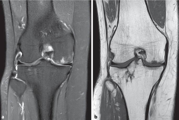 Diagnostik bei Knorpelschden des Kniegelenks: MRT und Umfelddiagnostik |  Knie Journal | Springer Nature Link