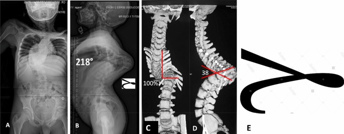 Characterization Of Complex Vertebral Transposition Gamma Deformity 180 Degrees Clinical And Radiographic Outcomes Of Halo Gravity Traction And Vertebral Column Resection Vcr Springerlink