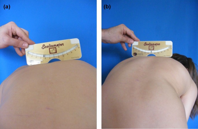 A Simple Method For Assessing Rotational Flexibility In Adolescent Idiopathic Scoliosis Modified Adam S Forward Bending Test Springerlink