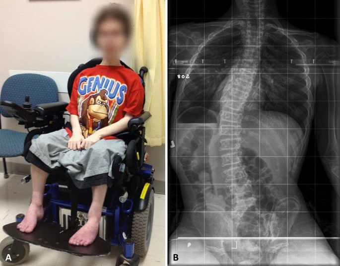 No difference in postoperative complication rates or cardiopulmonary function for early versus late scoliosis correction in Duchenne muscular dystrophy | Spine Deformity كيف يعمل حزام اعوجاج العمود الفقري أثناء الجلوس على الكرسي المتحرك؟