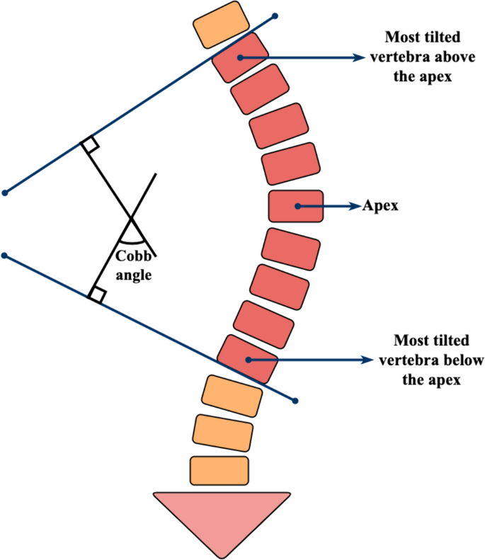 Deep learning in Cobb angle automated measurement on X-rays: a systematic  review and meta-analysis | Spine Deformity