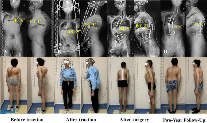 Application value of halo‑pelvic traction in the treatment of severe ...