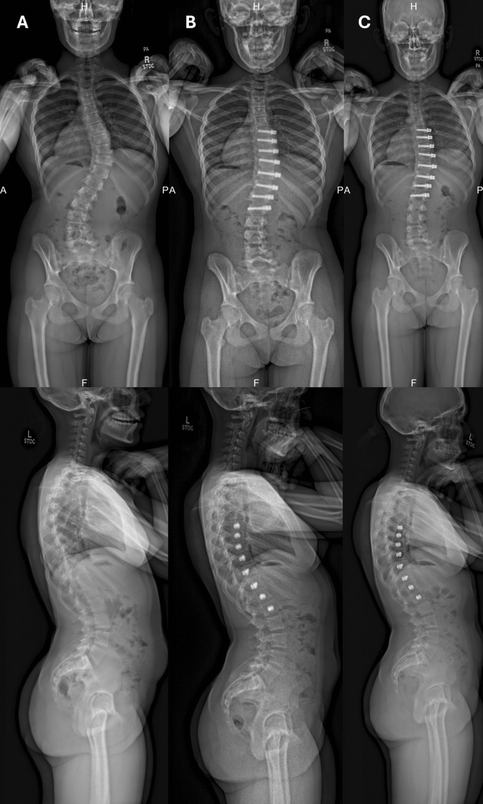 Sanders Maturity Does skeletal maturity influence vertebral body tethering outcomes ...