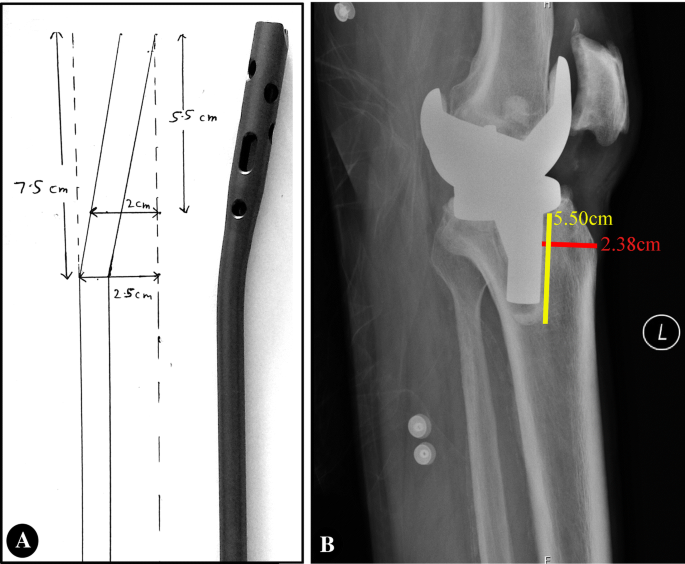 Management of Tibial Shaft Fractures Distal to TKA Prosthesis by Intramedullary Nail: A Report of Three Cases | SpringerLink Management of Tibial Shaft Fractures Distal to TKA Prosthesis by Intramedullary Nail: A Report of Three Cases | SpringerLink