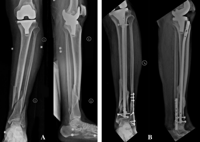 Management of Tibial Shaft Fractures Distal to TKA Prosthesis by  Intramedullary Nail: A Report of Three Cases | SpringerLink