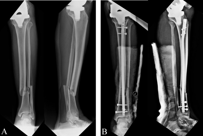 Management of Tibial Shaft Fractures Distal to TKA Prosthesis by Intramedullary Nail: A Report of Three Cases | SpringerLink Management of Tibial Shaft Fractures Distal to TKA Prosthesis by Intramedullary Nail: A Report of Three Cases | SpringerLink