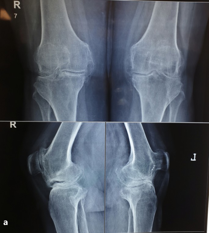 Ankolosing Spondylitis Ankylosing Spondylitis Chronic Fatigue Syndrome Diet Ankylosing Spondylitis Symptoms