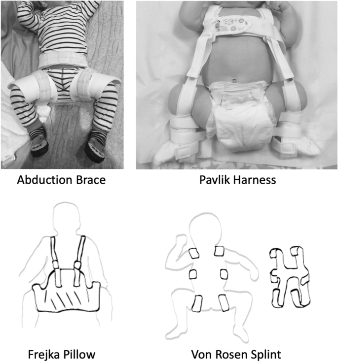 Principles of Bracing in the Early Management of Developmental ...