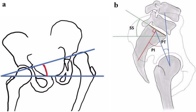 Imaging Parameters of Hip Dysplasia in Cerebral Palsy: A Systematic Review  | SpringerLink