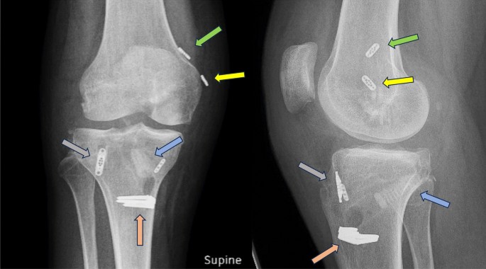 Adjustable Loop Fixation in Multi-ligament Knee Injuries: A Technical ...
