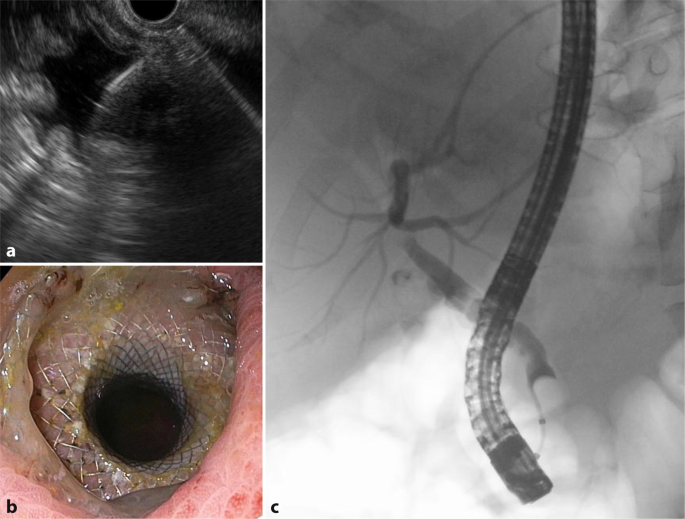 Die Flexible Endosonographie In Der Gastroenterologie Die Entwicklung Von Der Diagnostik Zur Therapie Springerlink