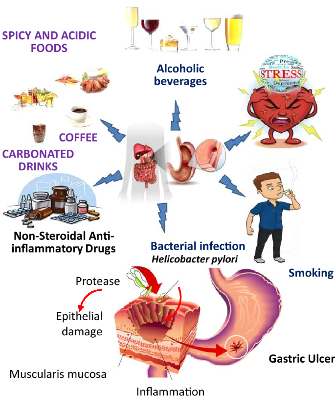 is glutathione good for stomach ulcers A comprehensive review on phytochemicals as potential therapeutic agents  for stress-induced gastric ulcer | Journal of Umm Al-Qura University for  Applied Sciences