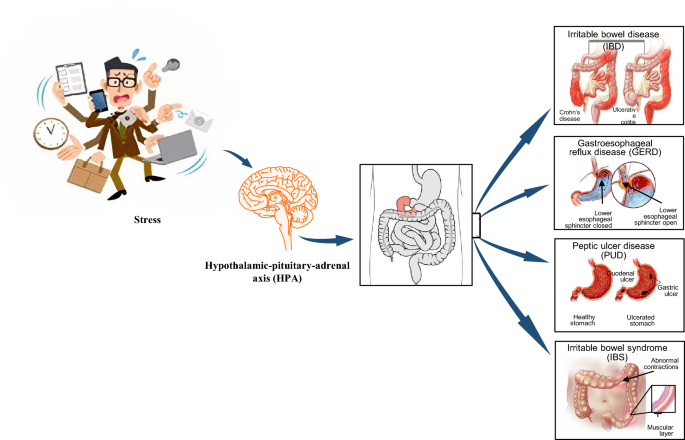 is glutathione good for stomach ulcers A comprehensive review on phytochemicals as potential therapeutic agents  for stress-induced gastric ulcer | Journal of Umm Al-Qura University for  Applied Sciences